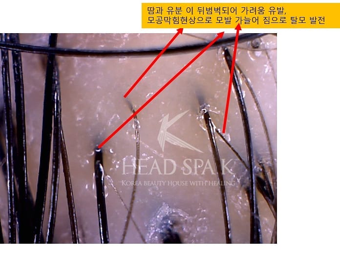 헤드스파k-두피 검사-땀과-유분.jpg