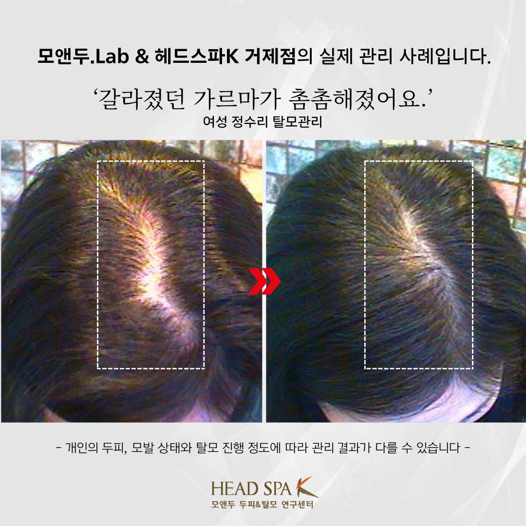 헤드스파k-거제점-모앤두랩-탈모-두피-관리-실제-사례.png