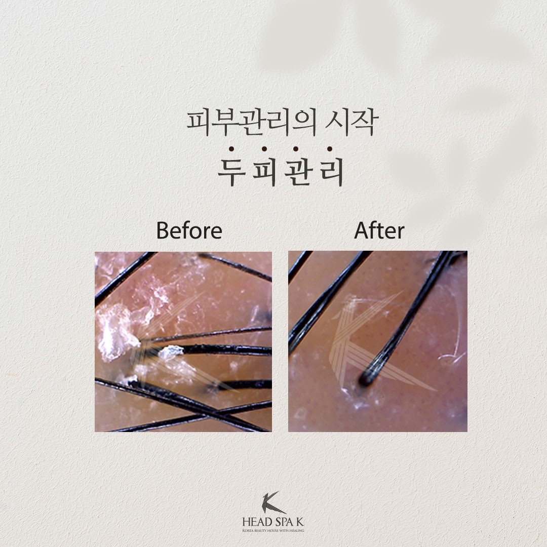 헤드스파k-두피관리의-시작.jpeg
