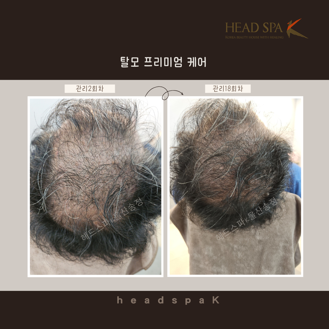 헤드스파k-탈모-프리미엄-케어-관리-변화.png