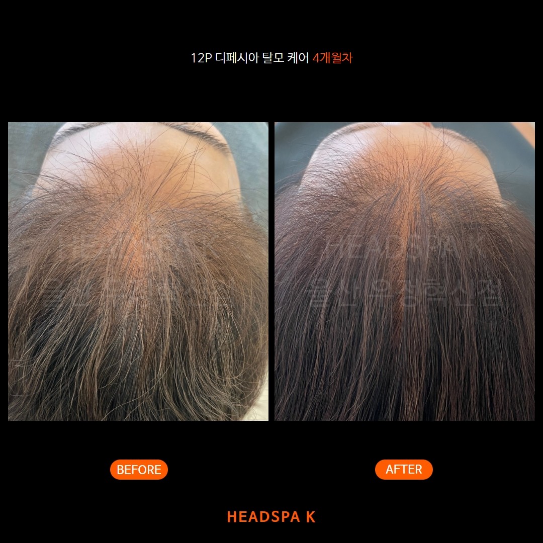 헤드스파k-탈모-케어-확실한-효과.jpeg
