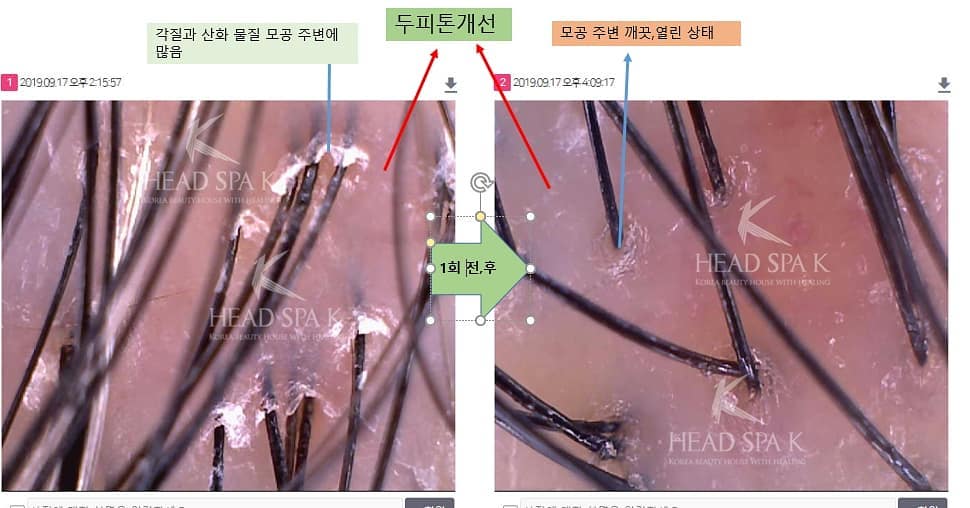 헤드스파k-두피-각질-개선-전후비교.jpg